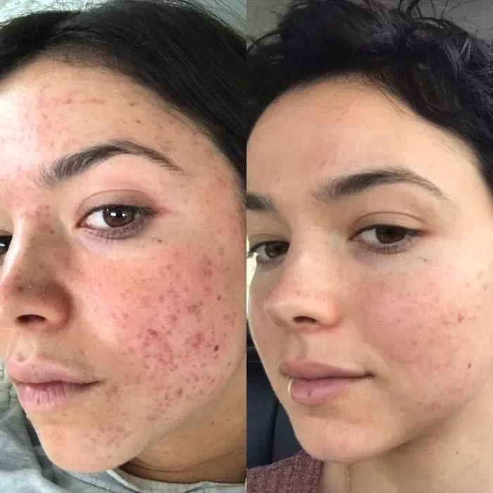 LED Light Facial Mask